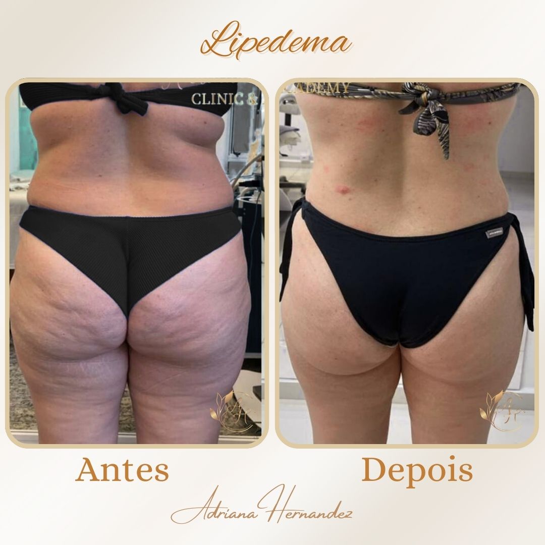 LIPEDEMA.jpg